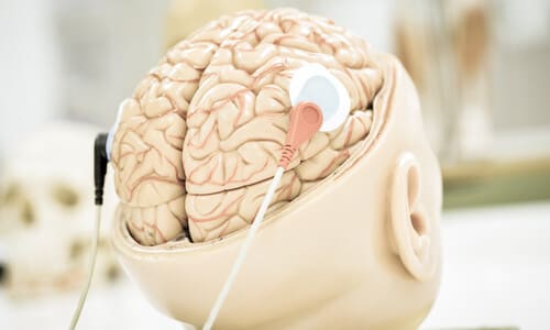 A model of a human head with electrodes attached to the lobes of the brain.