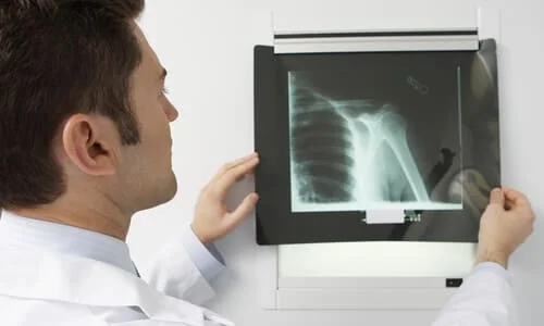 A doctor holding up an X-ray of a car accident victim's injured shoulder to the light.