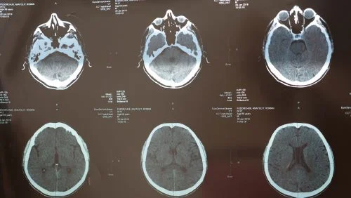 An MRI scan of a traumatic brain jury.